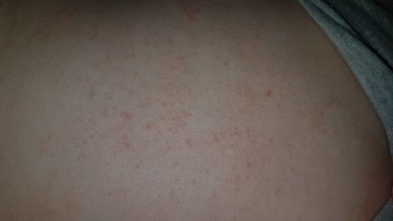 Сыпь и зуд на спине: причины красной мелкой сыпи и зуда на спине