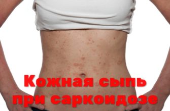 Кожная сыпь при саркоидозе