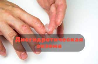 Дисгидротическая экзема