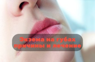 Экзема на губах причины