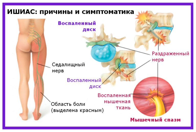 Жжение в попе после туалета