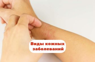 Виды кожных заболеваний