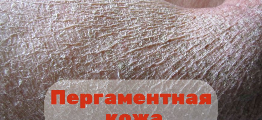 Пергаментная кожа