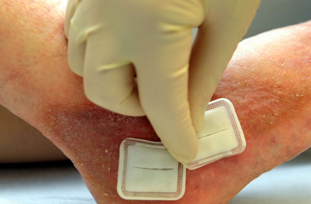 Пролежни что это: причины, симптомы и лечение пролежней