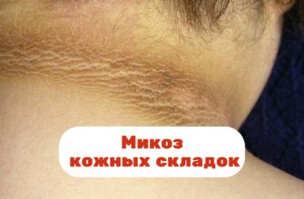 Микоз кожных складок