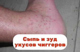 Сыпь и зуд укусов чиггеров