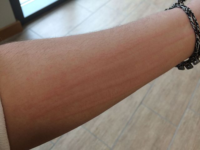 Физическая крапивница: что это, симптомы и лечение