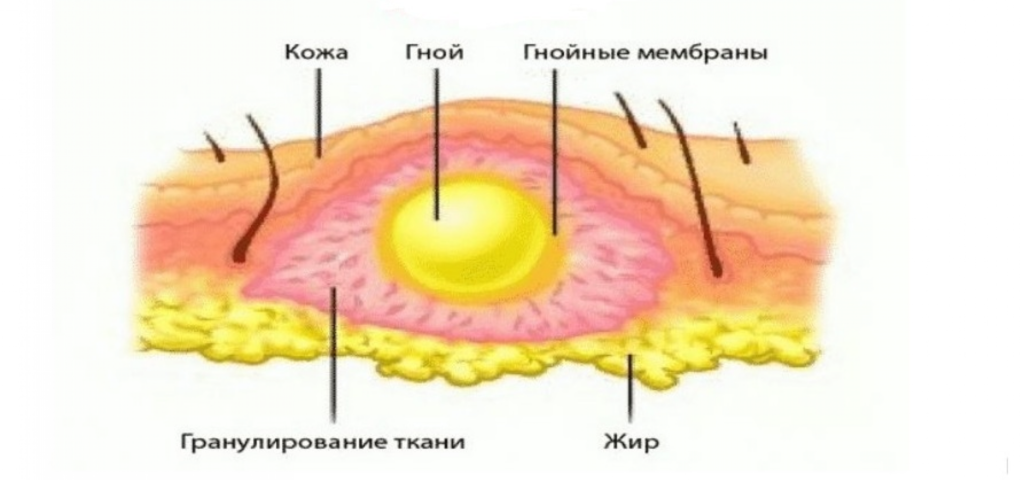 Множественные абсцессы кожи