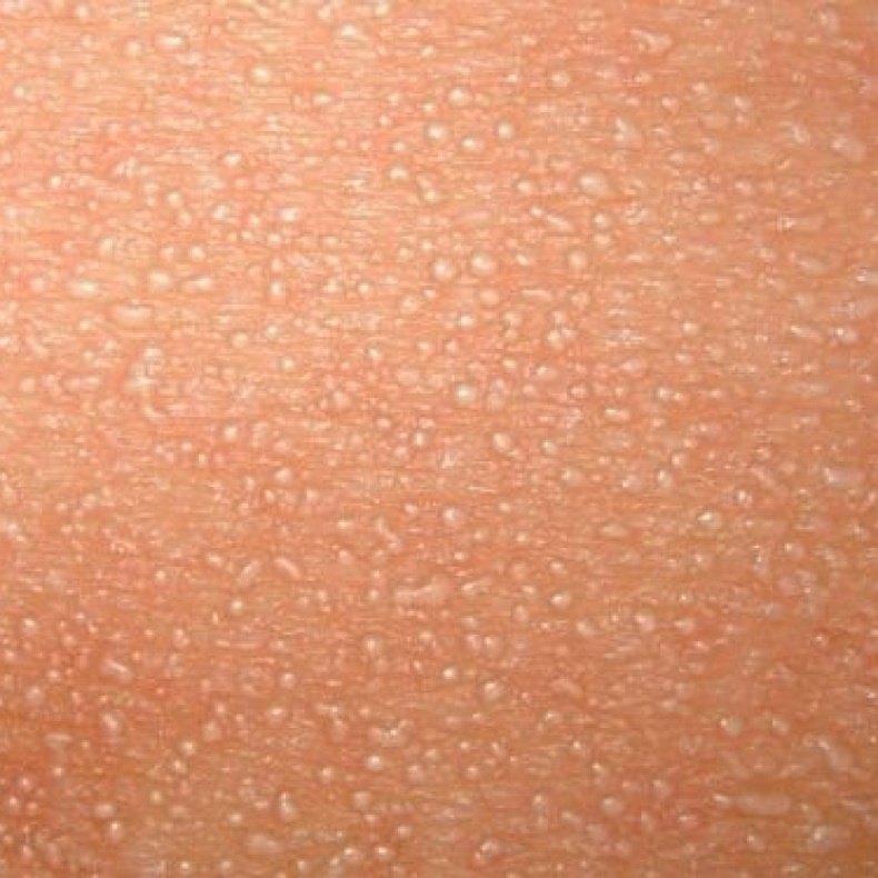 Потница у взрослых: причины, симптомы и лечение потницы у взрослых