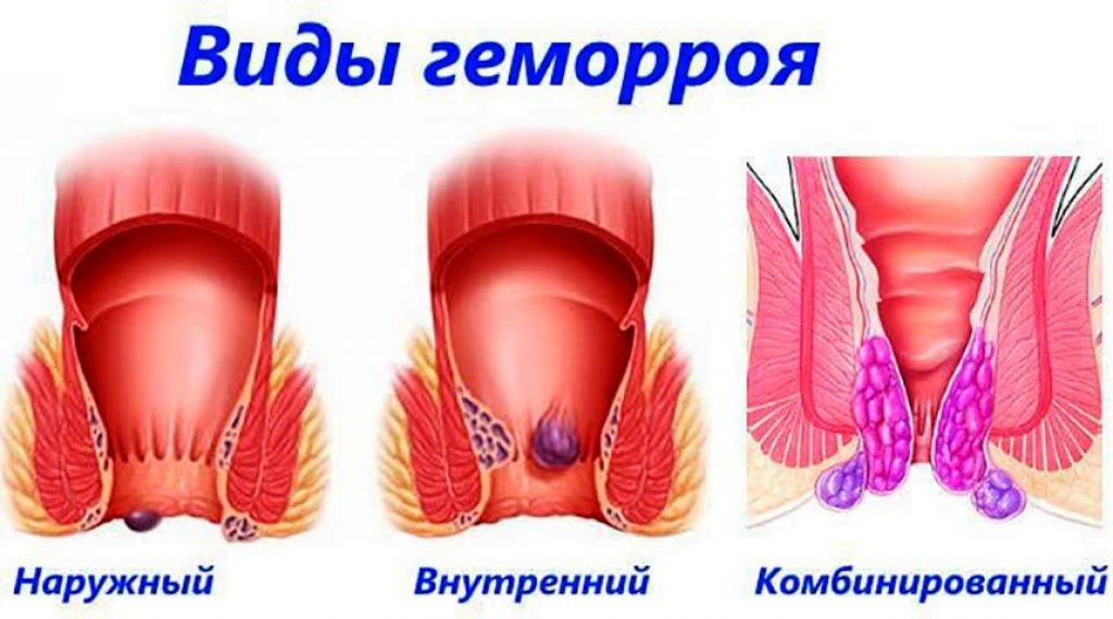 Жжет геморрой